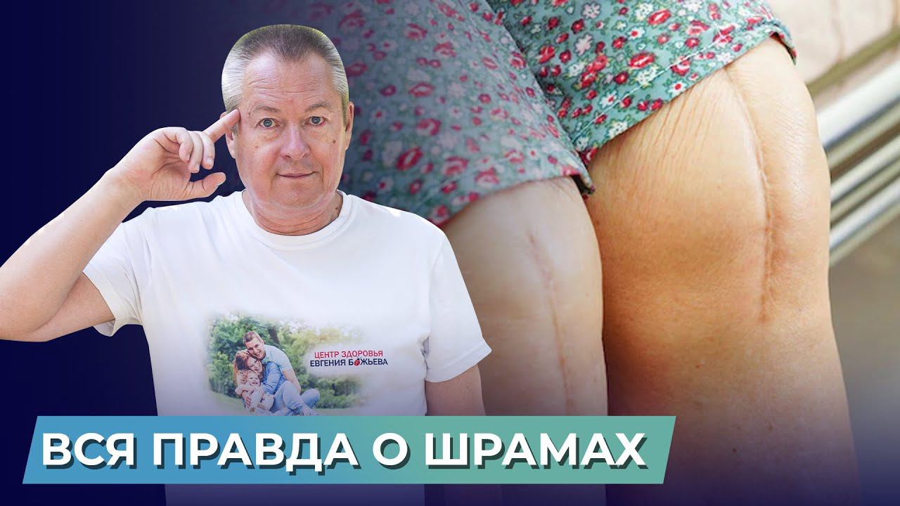 Самый быстрый способ ИЗБАВИТЬСЯ ОТ ШРАМОВ самостоятельно! смотреть онлайн