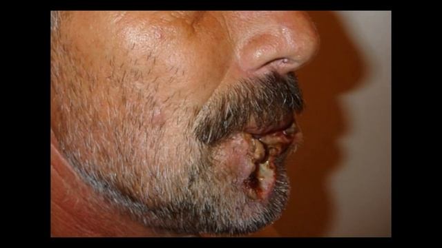 Рекомендационное видео от врача – стоматолога-хирурга ГАУЗ МО «БСП №1» Кузина В.В. смотреть онлайн