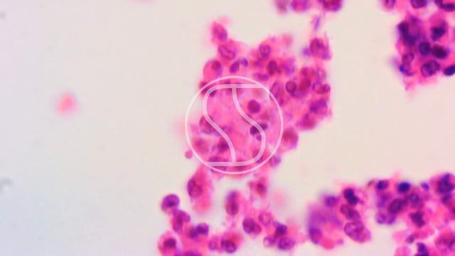 Actinomycosis under the microscope with Haematoxylin and Eosin (H&E) stain смотреть онлайн