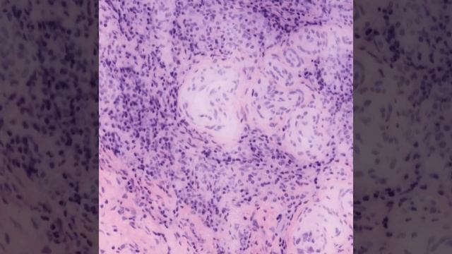OTLS3 20X axillary lymph node K1-1 met2 смотреть онлайн
