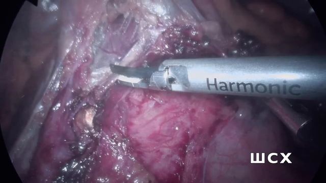 Резекция прямой кишки смотреть онлайн