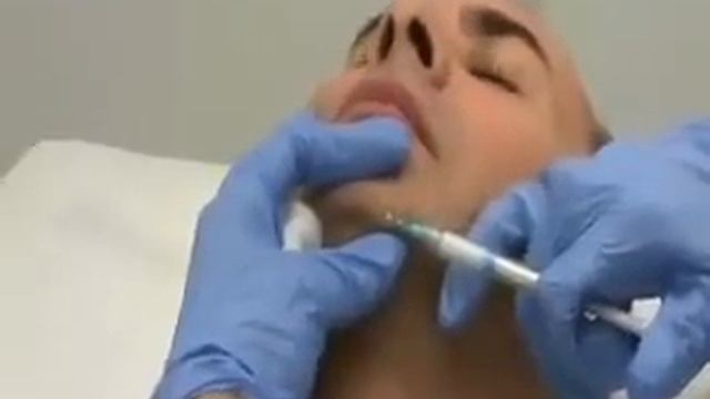Non-surgical Chin Augmentation by Dr. Yuriy Yagudin смотреть онлайн