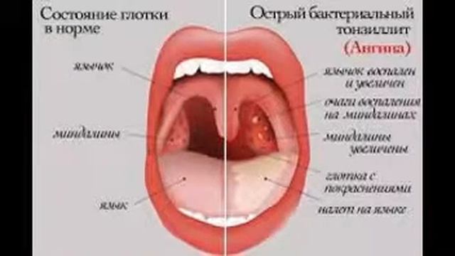 Чем полоскать горло? смотреть онлайн
