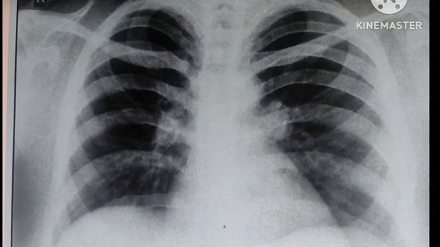 Hilar lymphadenopathy смотреть онлайн