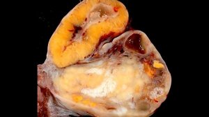 = ЧТО ТАКОЕ КИСТА ЖЕЛТОГО ТЕЛА ЯИЧНИКА? ОПАСНА ЛИ ПРИ БЕРЕМЕННОСТИ =