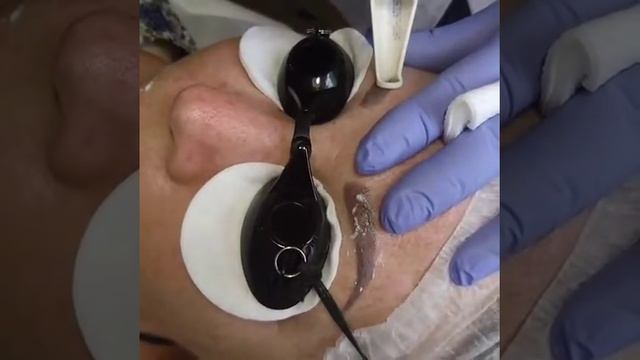 Лазерное удаление некачественного татуажа бровей в Студии Татуажа Ларисы Федоренко. смотреть онлайн