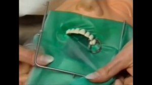 Наложение коффердама