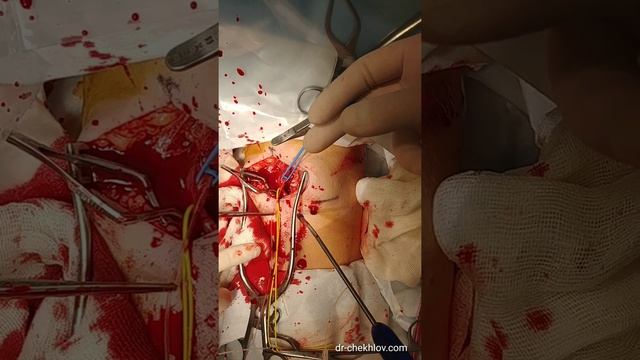 Тромб плечевой артерии. Удаление тромба. Доктор Чехлов М. В.