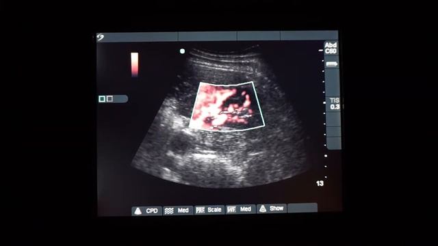 Sonosite Micromaxx обзор ультразвукового сканера смотреть онлайн