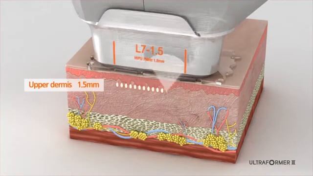 Смас лифтинг и моделирование лица,тела Ultraformer III смотреть онлайн