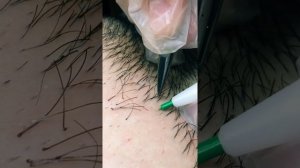 Электроэпиляция / процесс / Единственный метод удалить волосы НАВСЕГДА