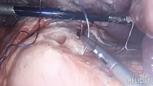 Перфорация язвы желудка и двенадцатиперстной кишки.