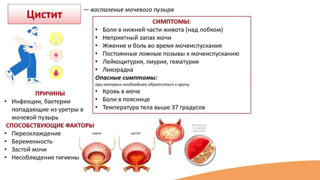 8.3. Мочекаменная болезнь. Цистит. Уретрит смотреть онлайн