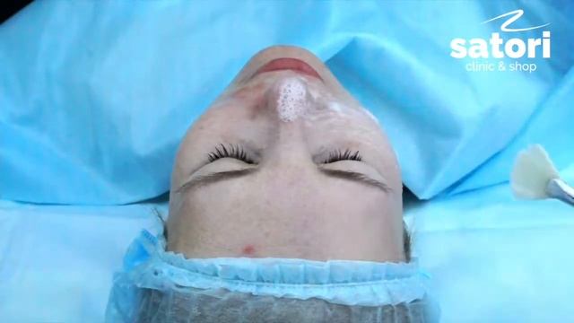 Гликолевый пилинг в Самаре