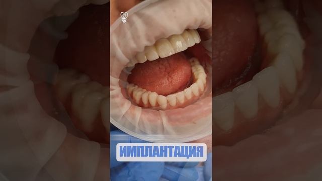 Имплантация. До и после. Implantation смотреть онлайн