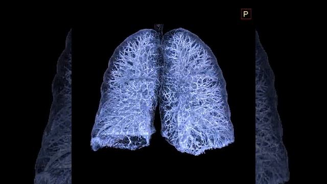 iRAD-KA-Bronchialbaum Lunge CT 3D reconstruction смотреть онлайн