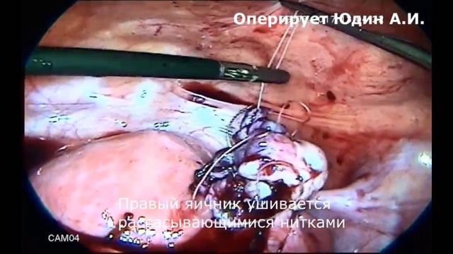 13 Лапароскопия. Двустороннии эндометриоидные кисты яичников смотреть онлайн