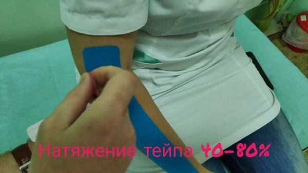 Тейпирование при перегрузки разгибателей запястья. Локоть теннисиста. Эпикондилит локтевого сустава