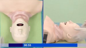 Надгортанный воздуховод. Обеспечение проходимости верхних дыхательных путей.