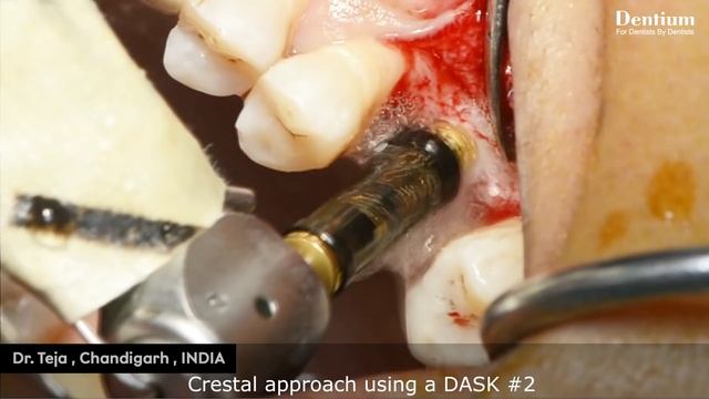 Crestal approach sinus lift & implantation using DASK & OSTEON™∥ -Dr. Teja смотреть онлайн