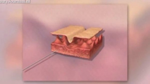 Pascaud BioSkinJetting