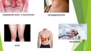 Инфекционный мононуклеоз