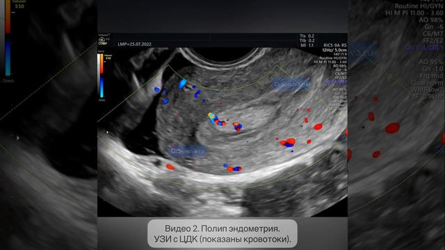Видео 2. Полип эндометрия. УЗИ с ЦДК (показаны кровотоки). смотреть онлайн