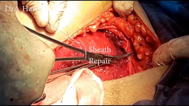 Standard Caesarean Section Technique
