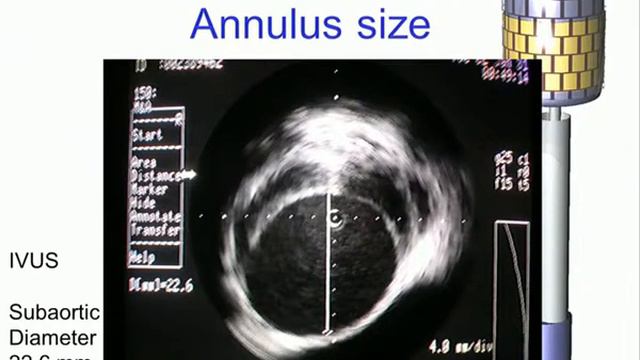 Ludwig Karl Von Segesser. Echo-guided cardiovascular surgery смотреть онлайн