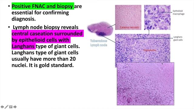 Tuberculous lymphadenitis,cervical lymphadenitis Treatment diagnosis and investigations смотреть онлайн