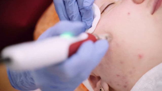 Биорепил . Biorepeel лучший пилинг