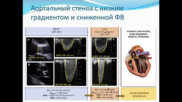 (2023.03.27) Месяц Наталья Сергеевна - Аортальный порок сердца смотреть онлайн