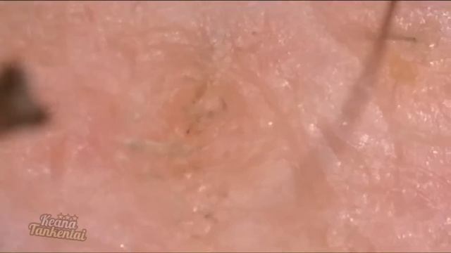 The  BEST Pimple POPPING Videos EVER (p2)