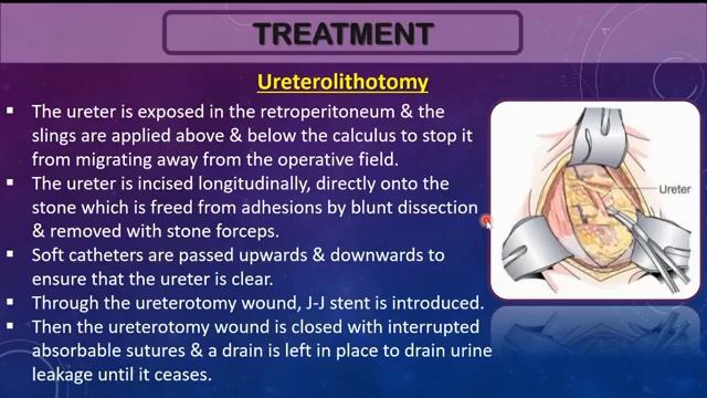 Surgery | Ureteric & vesical calculus смотреть онлайн