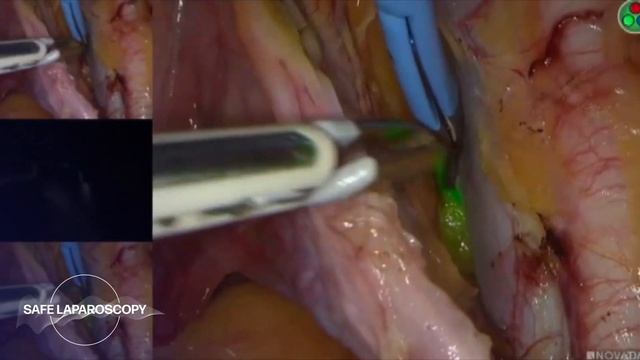 Sentinel Lymph Node Dissection with Use of ICG Real-time PINPOINT/SPY Technology | Safe Laparoscopy смотреть онлайн