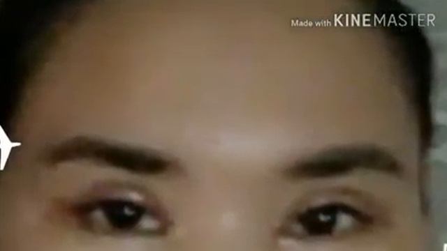 Отзыв пациентки после блефаропластики верхних век 87027471177 RB CLINIC смотреть онлайн