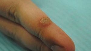 БОРОДАВКИ: причины ПОЯВЛЕНИЯ и как их ЛЕЧИТЬ?