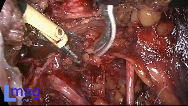 Иссечение эндометриоидного инфильтрата. Передняя локализация поражения (мочевой пузырь) смотреть онлайн