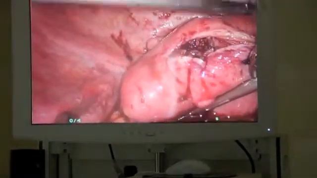 Трокар VECTEC 12060 ушивание раны после миомэктомии смотреть онлайн