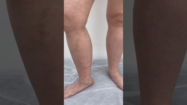 Рецидив варикоза. Как лечить варикоз? Ч.1 флеболог Москва. Флеболог. Сосудистый хирург смотреть онлайн