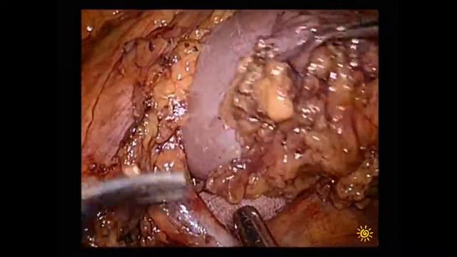 Transmesocolic partial nephrectomy/Трансмезентериальная резекция почки смотреть онлайн