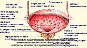 Утолщение стенки мочевого пузыря