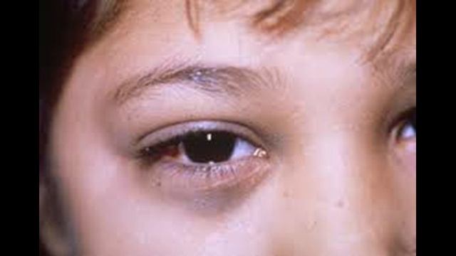 Как лечить и Лечение нейробластома смотреть онлайн