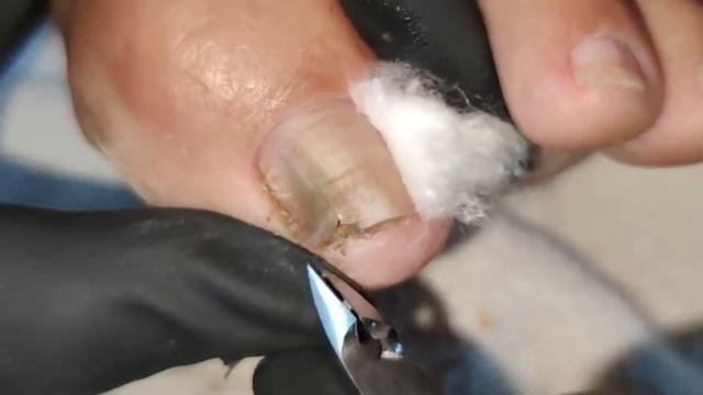 DEEP CLEANING ON THIS FUNGUS NAIL #nails #ingrowntoenail смотреть онлайн