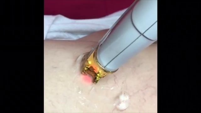 HOW TO REMOVE VARICOSE VEINS PERMANENTLY? made possible by CUTERA Laser Vein Removal смотреть онлайн