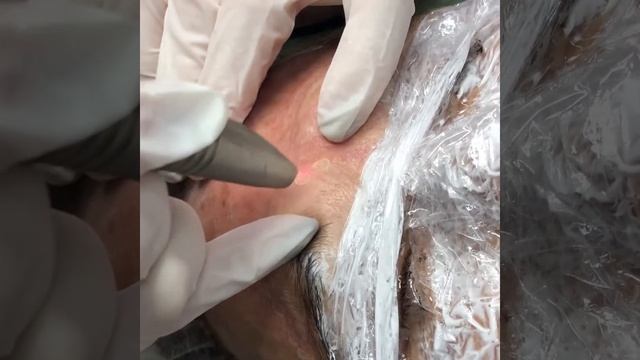 Лазерная шлифовка лица. Салон Лилу Кременчуг смотреть онлайн