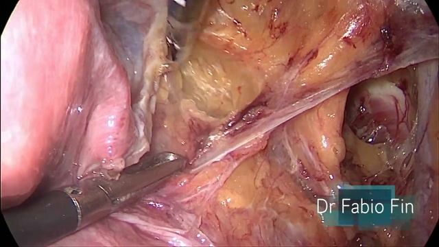 Laparoscopic Sentinel lymph node cervical cancer смотреть онлайн