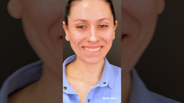 Пластика ушей #отопластика
