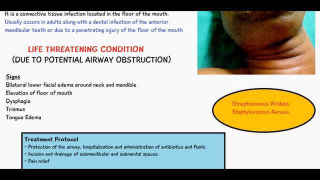 Ludwig's Angina | Explained in 2 minutes! Signs, Symptoms and Treatment | Angina Ludovici смотреть онлайн