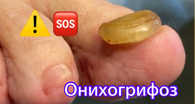 Онихогрифоз ?⚠️❗️?? смотреть онлайн